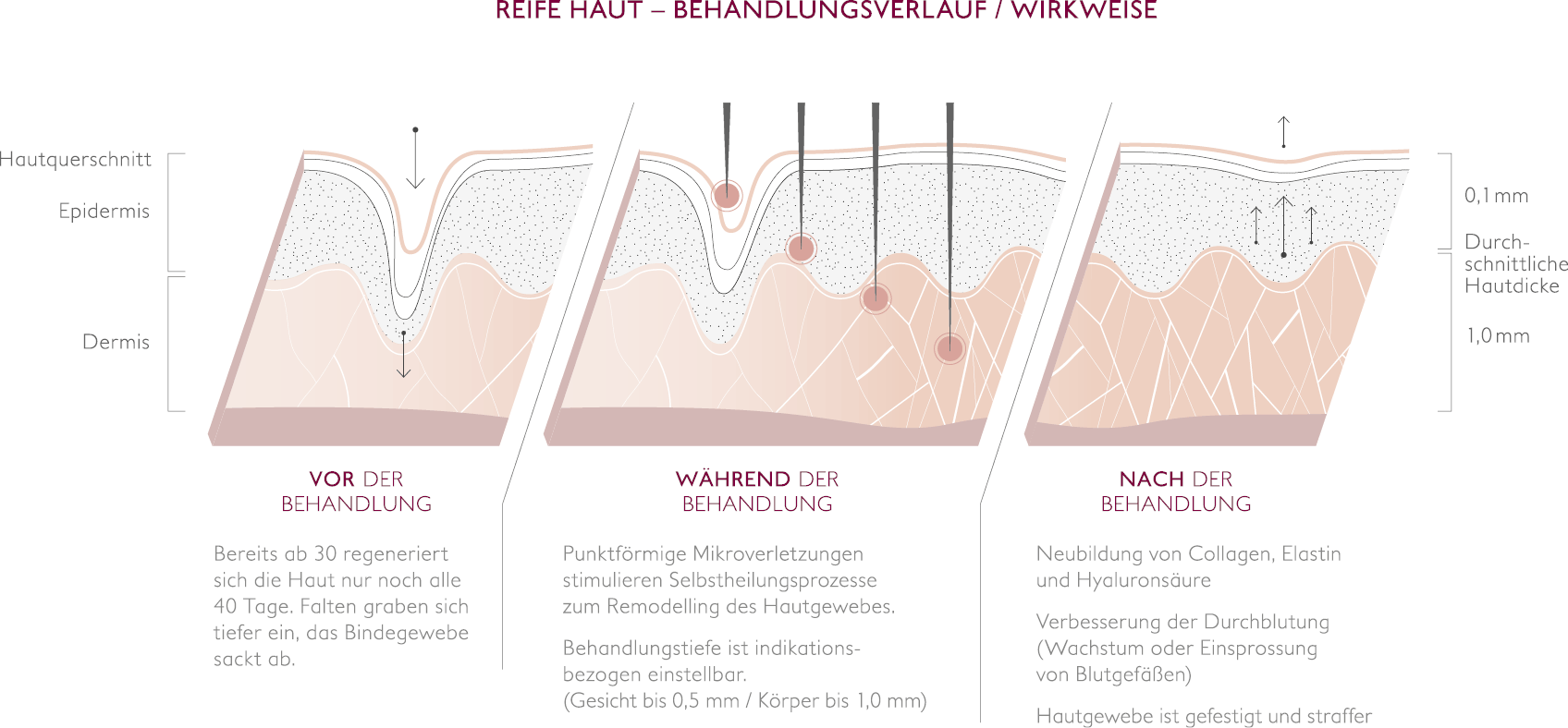 microneedling wirkung